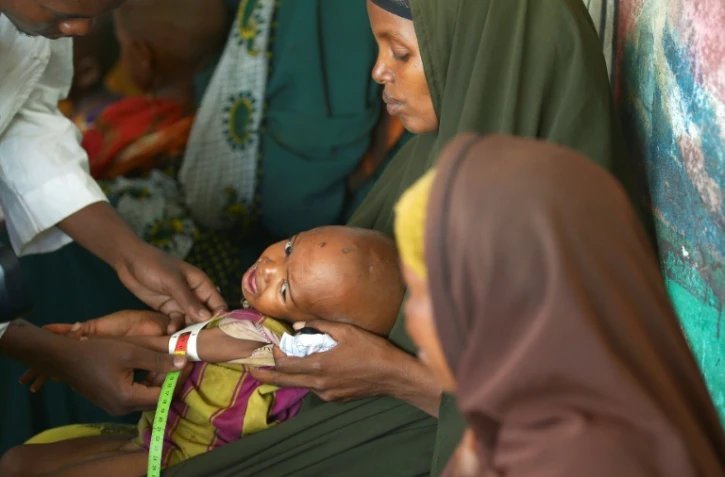 Un enfant dénutri est pris en charge par un travailleur humanitaire dans un centre de santé de l'Unicef à Baidoa, le 15 mars 2017 dans le sud-ouest de la Somalie