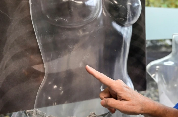 Un couteau de boucher enfoncé dans la cage thoracique d'une femme visible sur une radiographie lors de l'exposition sur les violences faites aux femmes à l'hôpital San Carlo de Milan, le 22 novembre 2019 