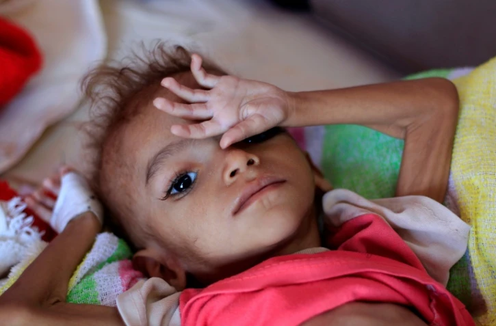 Un enfant yéménite souffrant de malnutrition. Photo prise le 6 octobre 2018 dans un hôpital de Sanaa
