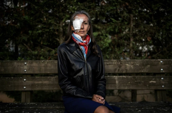 La spectatrice française Corine Remande, qui a perdu la vue à l'?il droit après avoir été blessée par une balle de Brooks Koepka lors de la journée d'ouverture de la Ryder Cup, ici à Lyon le 3 octobre 2018