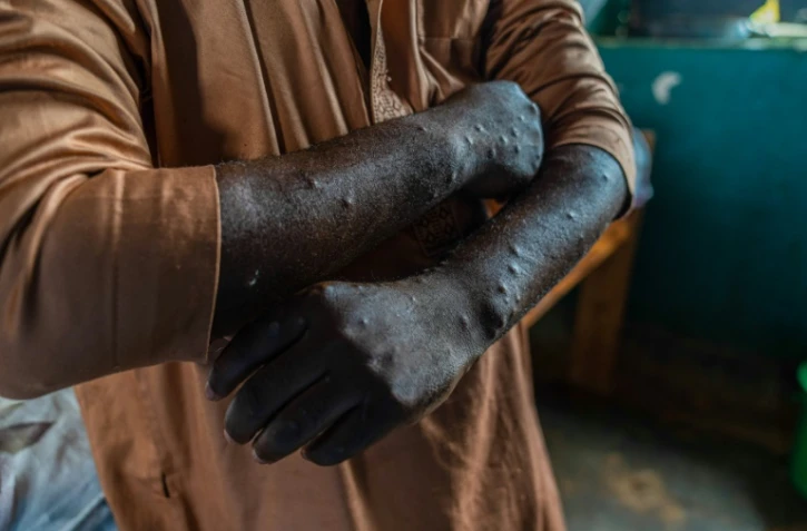 Un patient infecté par le mpox à Kamituga, le 20 septembre 2024 dans l'est de la RDC