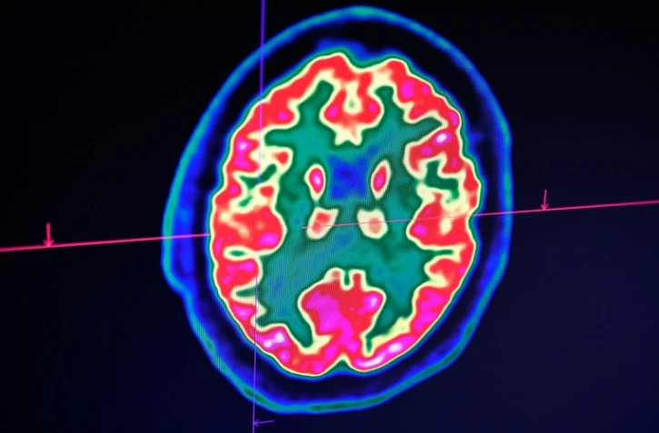 Des médecins ont constaté chez des malades graves du Covid-19 des symptômes neurologiques allant de la perte d'odorat à des douleurs nerveuses, et jusqu'à des crises convulsives et des accidents vasculaire cérébraux (AVC).