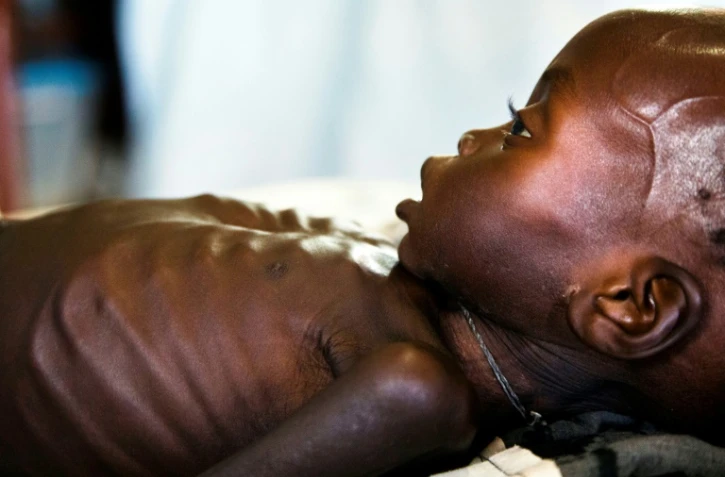 Agop Manut, un bébé de onze mois souffrant de malnutrition, est soigné dans une clinique de Médecins sans frontières, le 11 octobre 2016 à Aweil, au Soudan du Sud