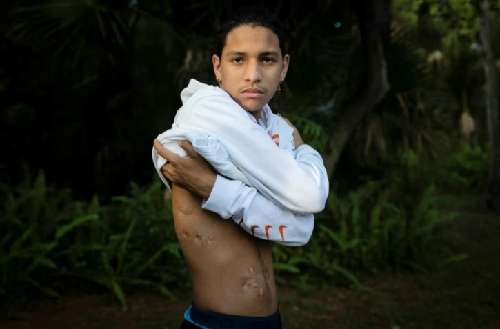 Anthony Borges dévoile ses cicatrices lors d'une interview avec l'AFP à Coral Springs en Floride, le 9 août 2019. L'adolescent a été blessé le 14 février 2018 lors de la fusillade de Parkland