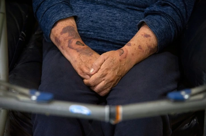 Les bras de Marisela Oliva bleuis par les coups de son ex-compagnon, le 20 juin 2021 à Mexico