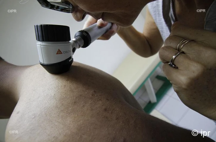 dépistage cancer de la peau